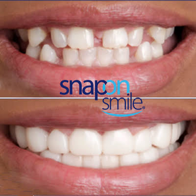 Snap On Smile (RO) 5